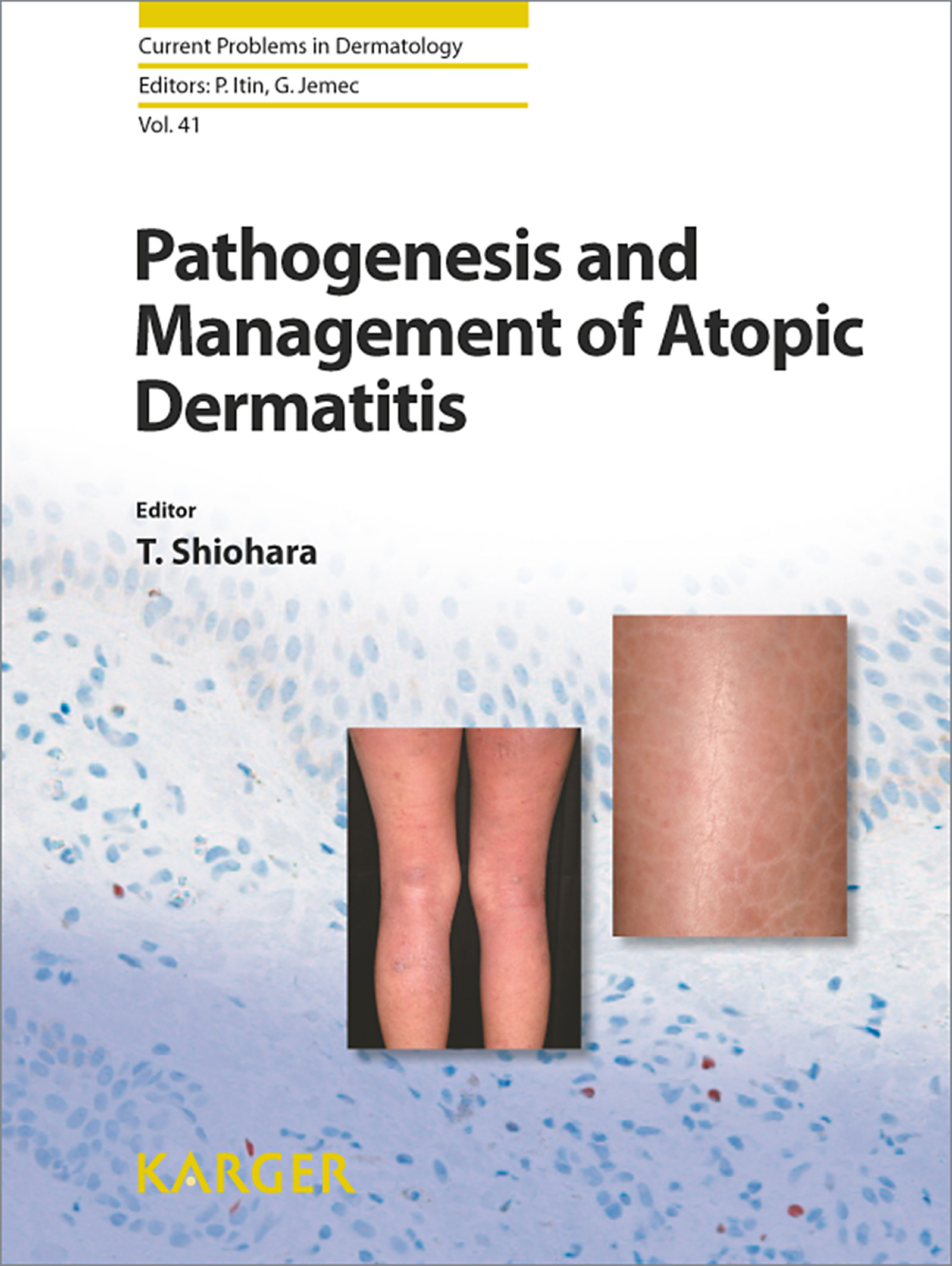 Pathogenesis and Management of Atopic Dermatitis - E-Book