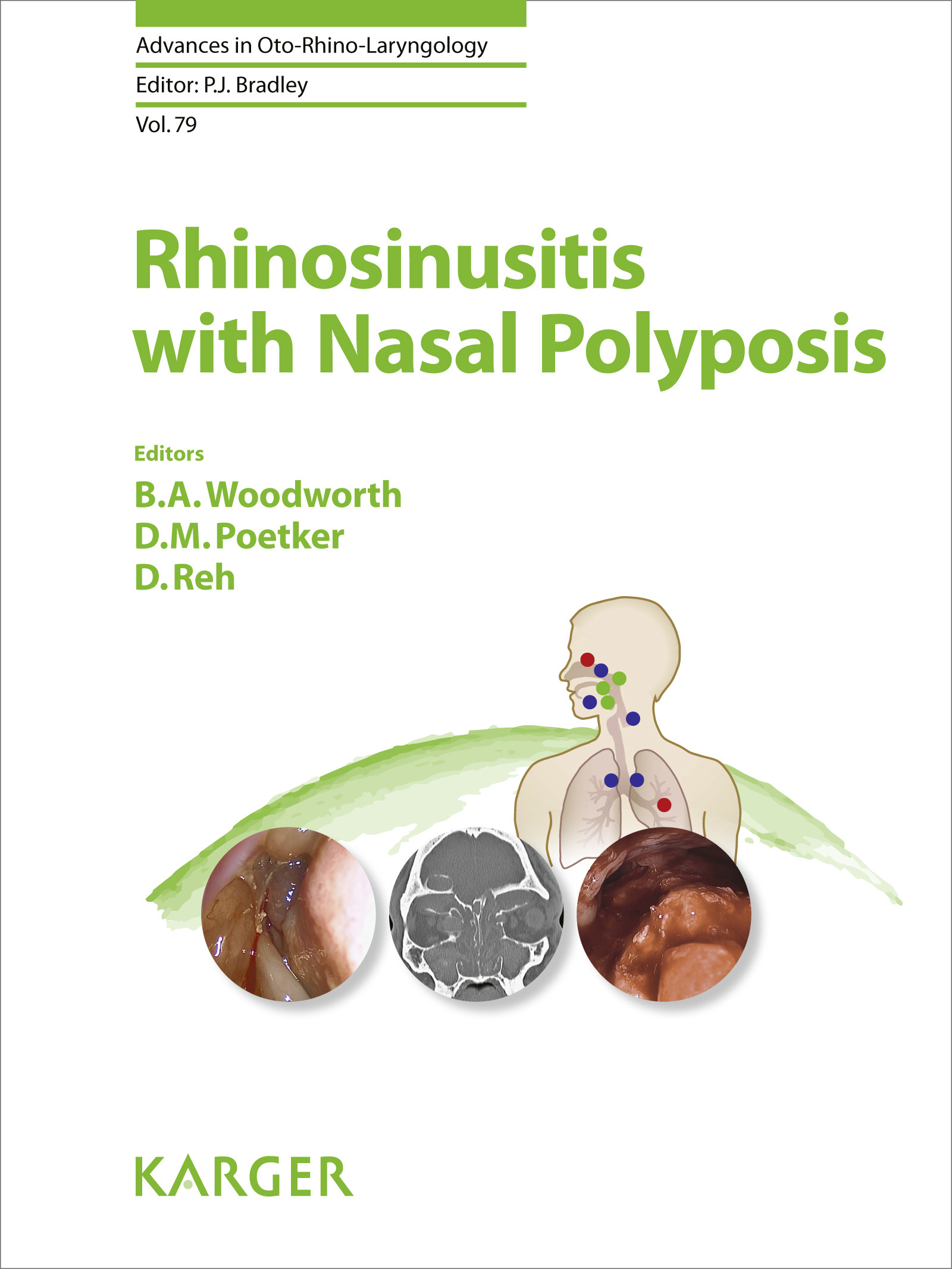 Cover Rhinosinusitis with Nasal Polyposis