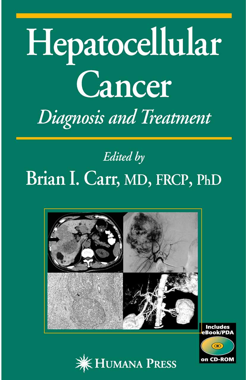 Hepatocellular Carcinoma