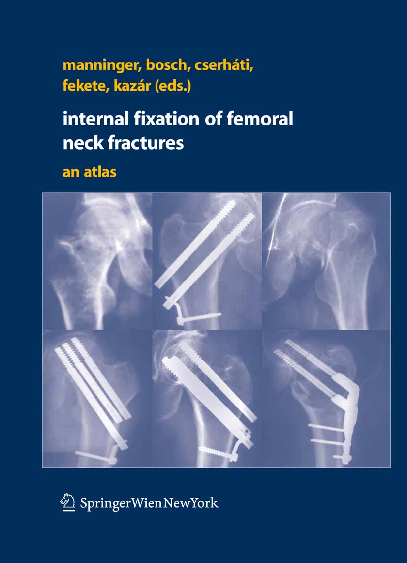 Cover Internal fixation of femoral neck fractures