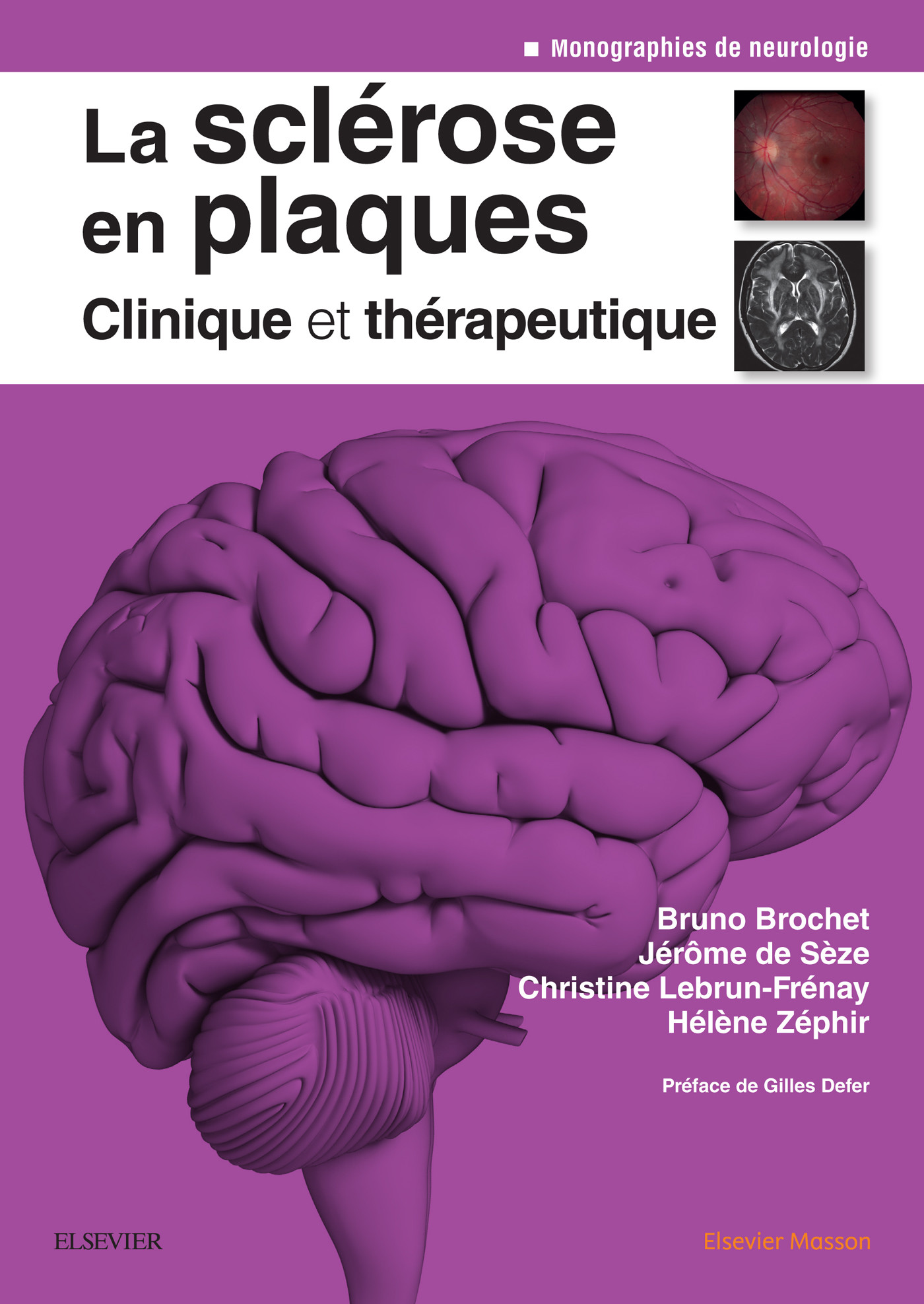 La Sclérose En Plaques - Clinique Et Thérapeutique - E-Book