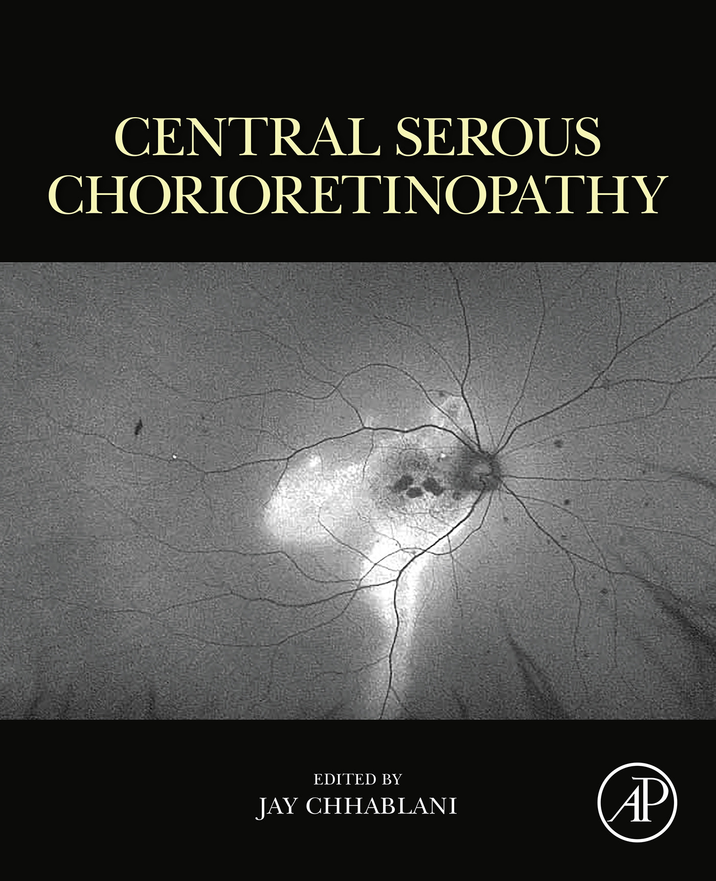 Central Serous Chorioretinopathy