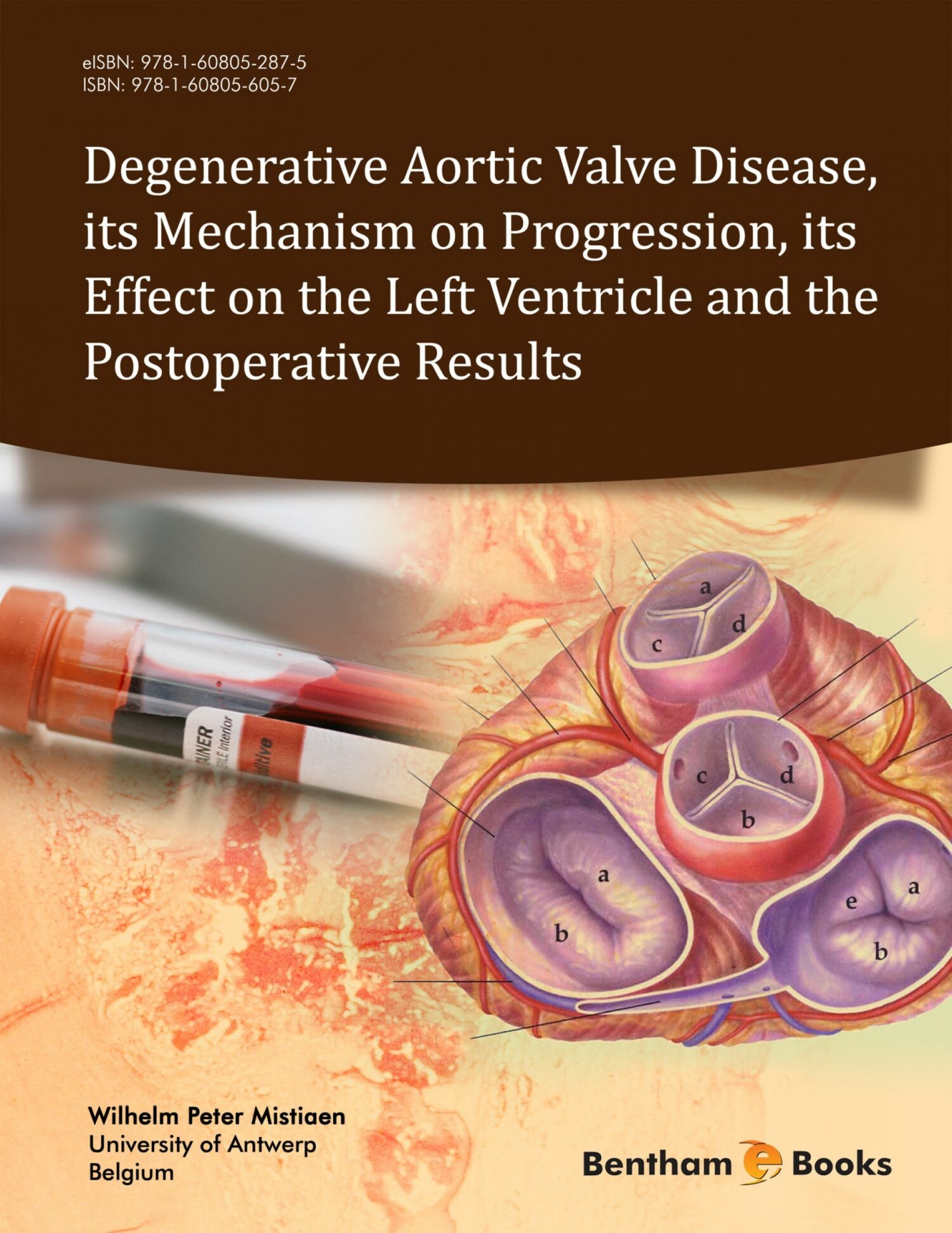 Degenerative Aortic Valve Disease, its Mechanism on Progression, its Effect on the Left Ventricle and the Postoperative Results