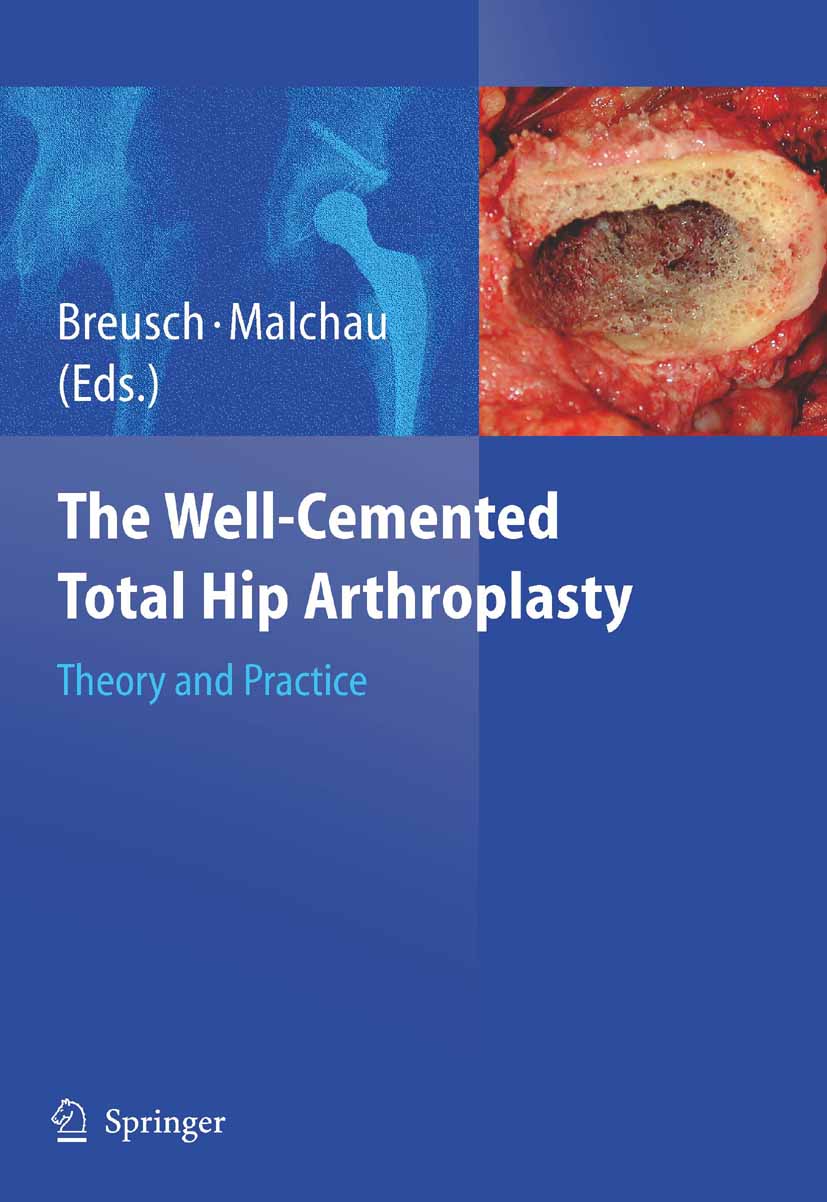 The Well-Cemented Total Hip Arthroplasty