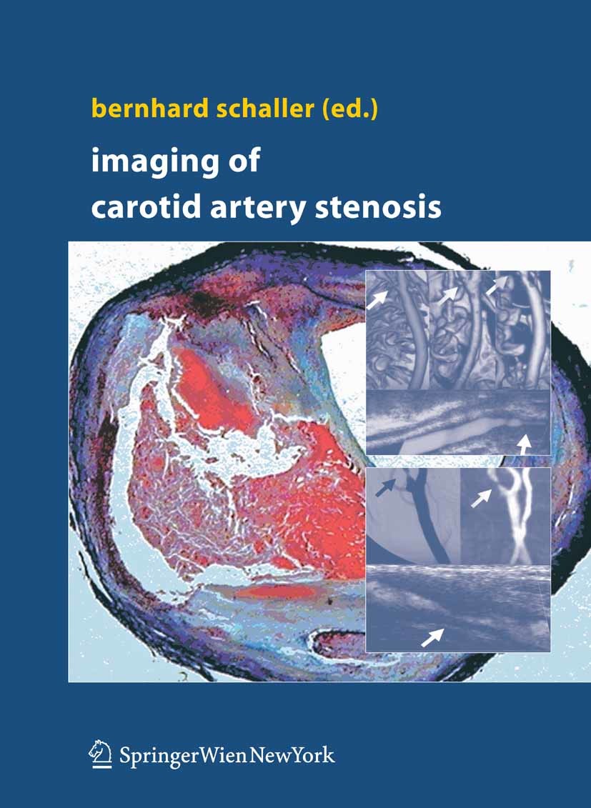 Cover Imaging of Carotid Artery Stenosis