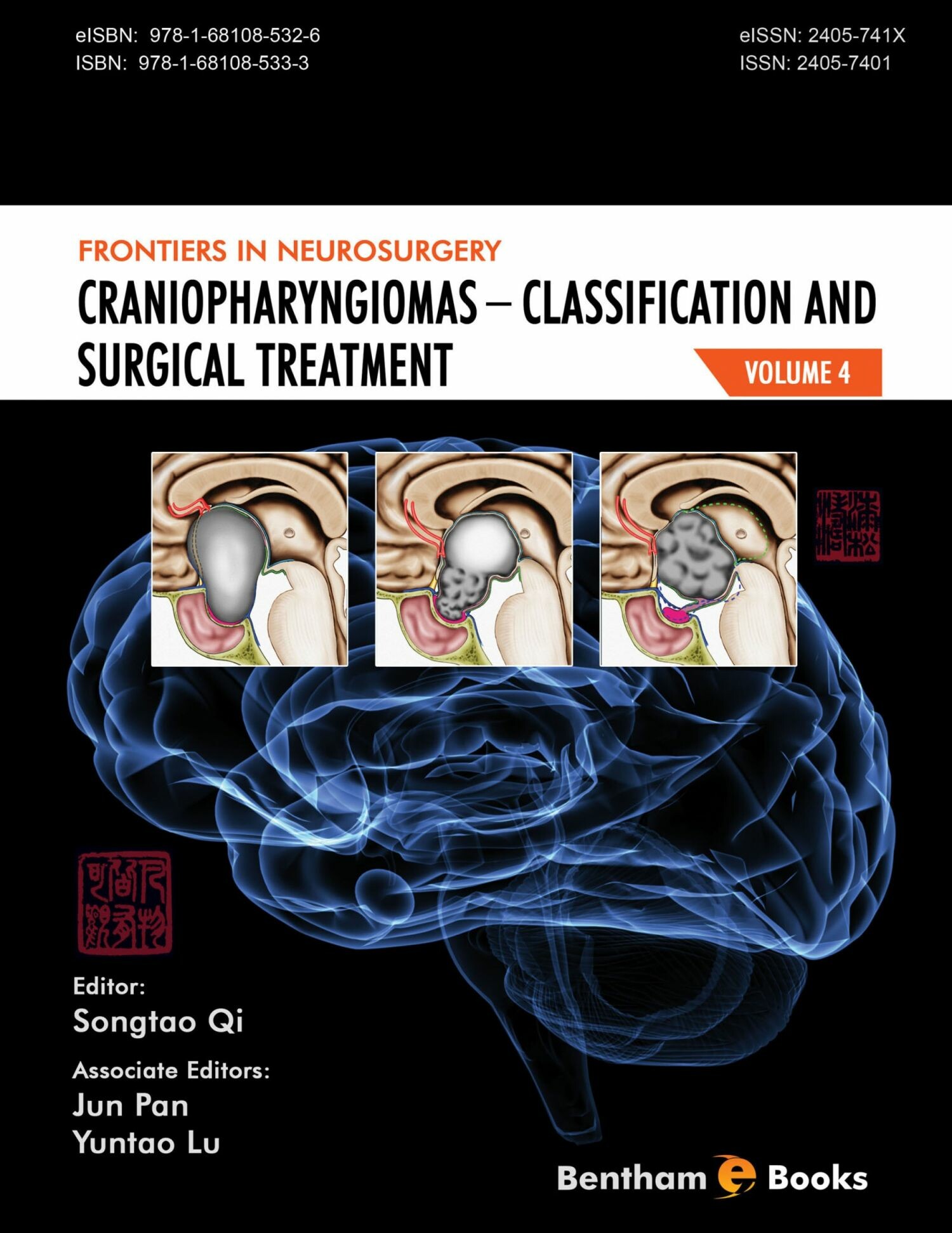 Cover Craniopharyngiomas - Classification and Surgical Treatment