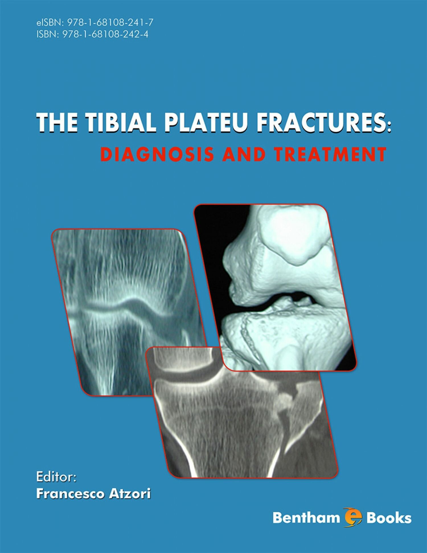 Cover The Tibial Plateau Fractures: Diagnosis and Treatment