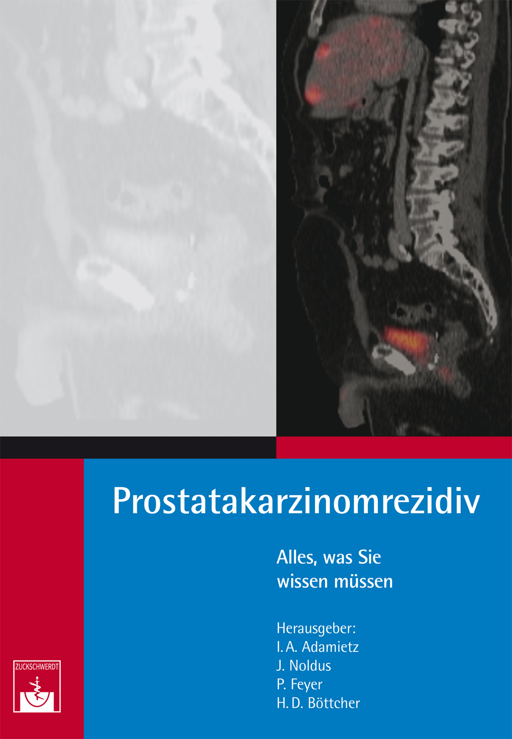 Cover Prostatakarzinomrezidiv