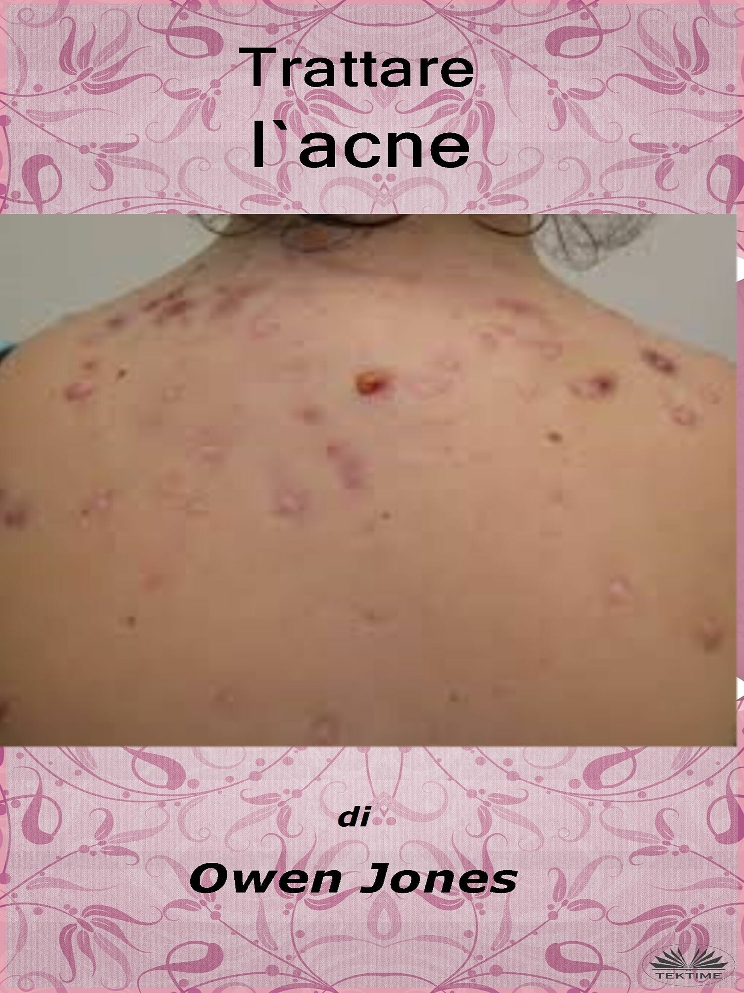Cover Trattare L'Acne