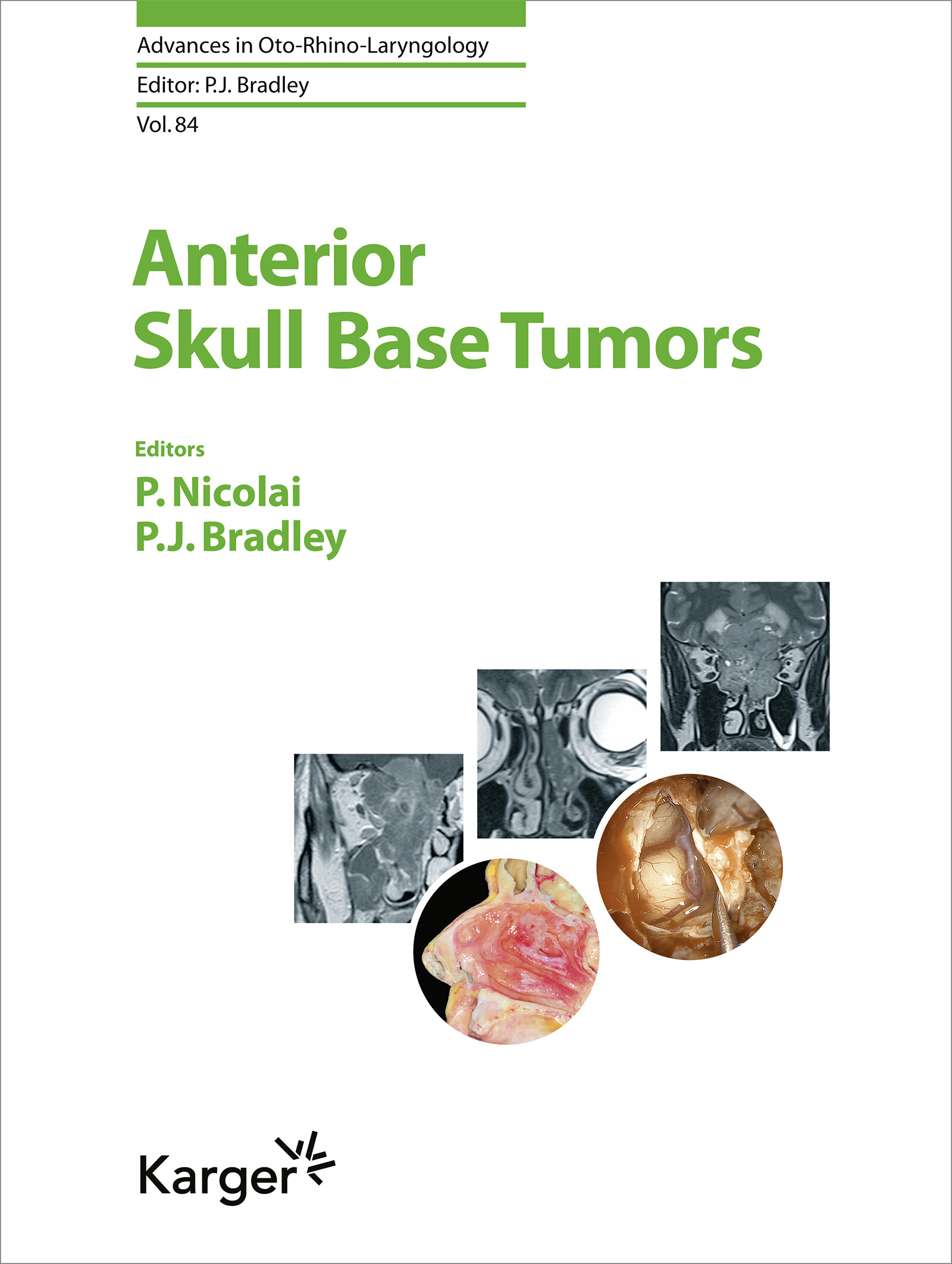 Cover Anterior Skull Base Tumors