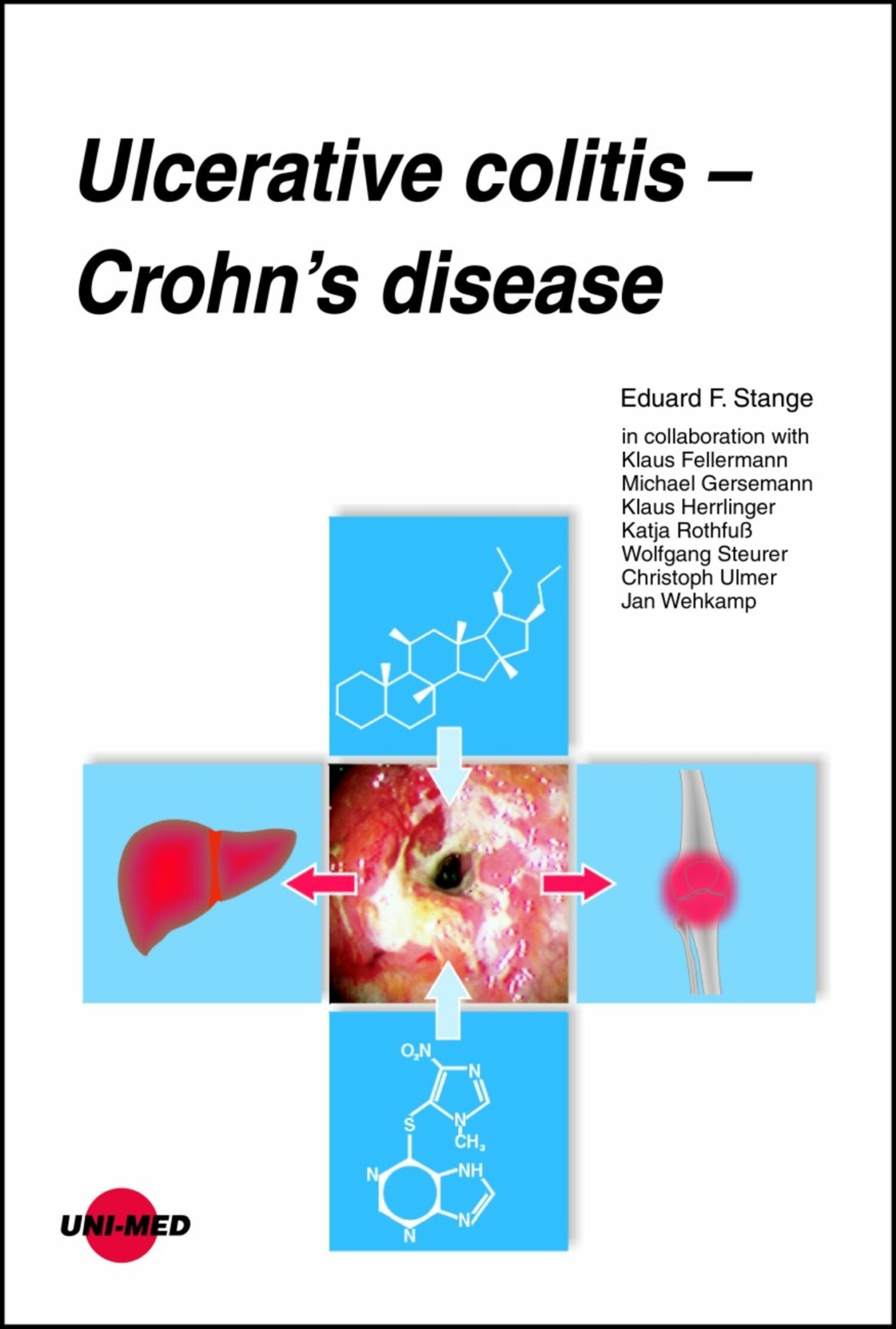 Cover Ulcerative colitis - Crohn's disease