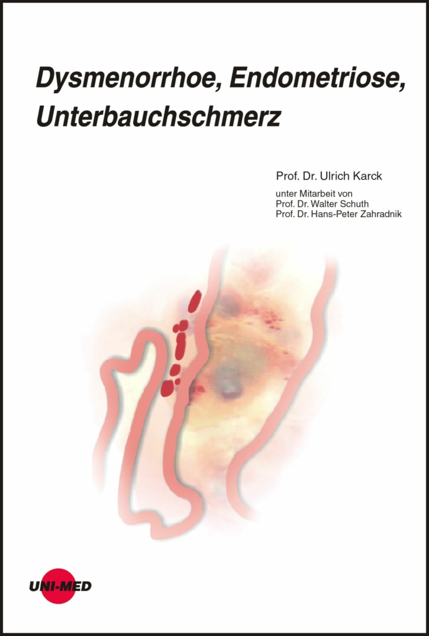 Cover Dysmenorrhoe, Endometriose, Unterbauchschmerz