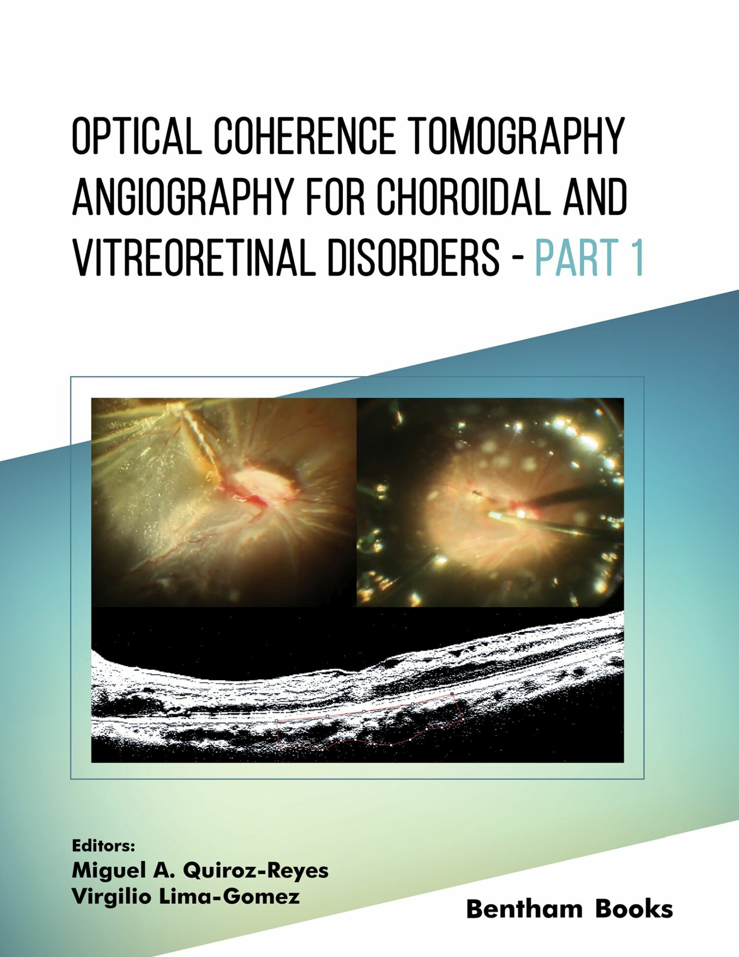 Cover Optical Coherence Tomography Angiography for Choroidal and Vitreoretinal Disorders - Part 1