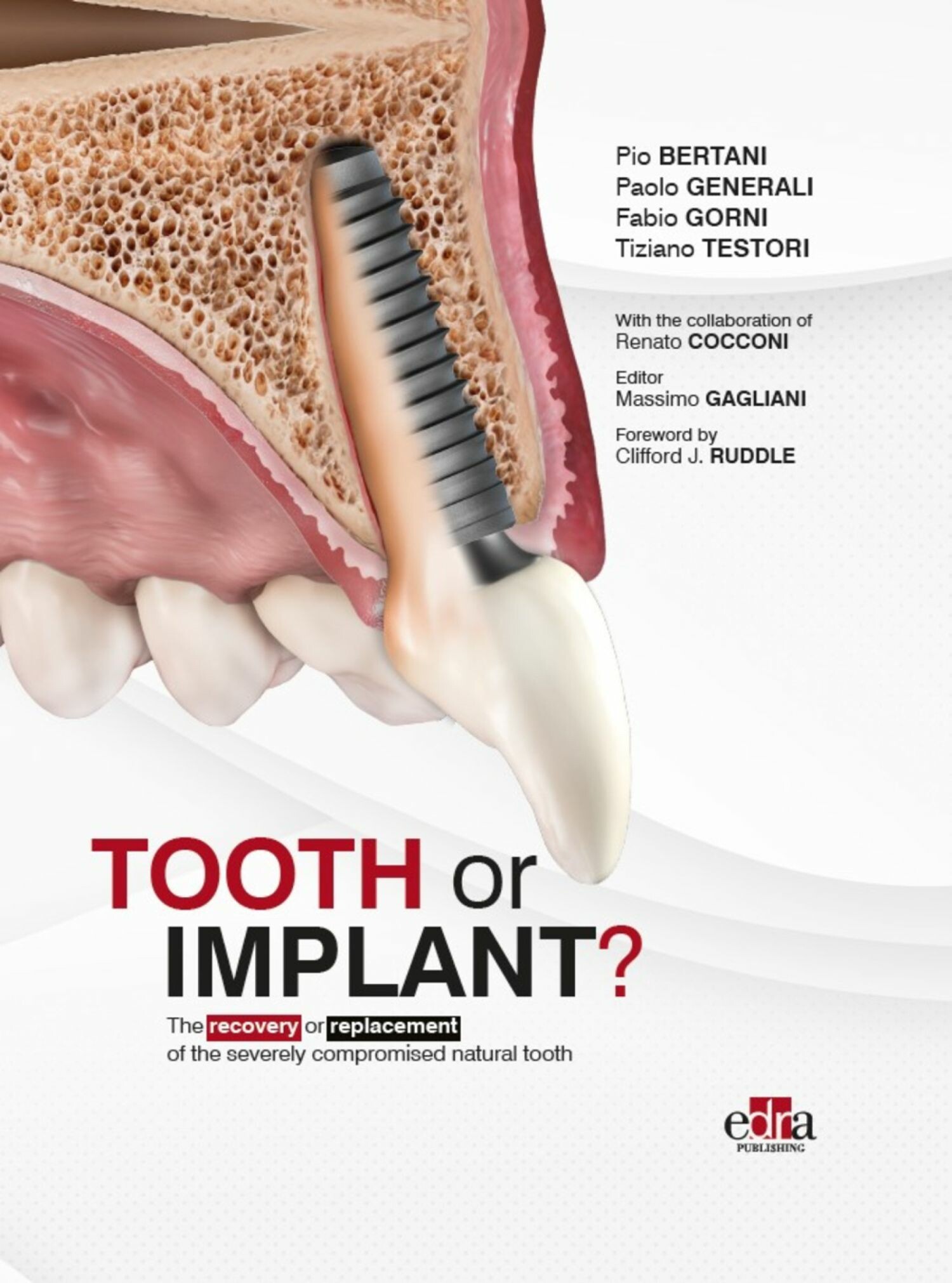 Cover Tooth or Implant?
