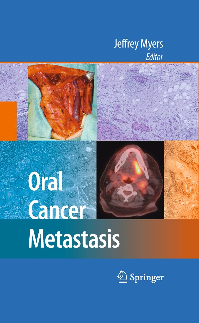 Cover Oral Cancer Metastasis