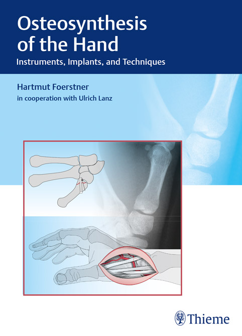 Osteosynthesis of the Hand