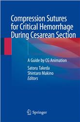Cover Compression Sutures for Critical Hemorrhage During Cesarean Section