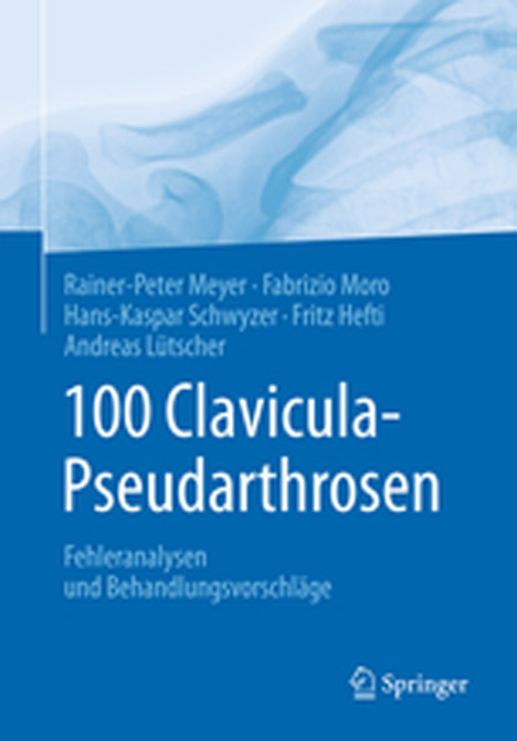 100 Clavicula-Pseudarthrosen