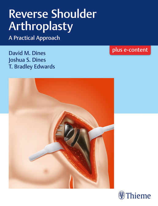 Reverse Shoulder Arthroplasty