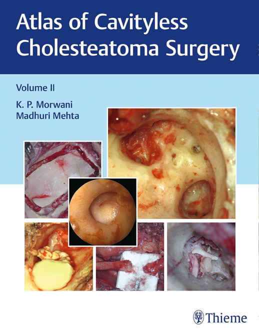 Atlas of Cavityless Cholesteatoma Surgery, Vol 2