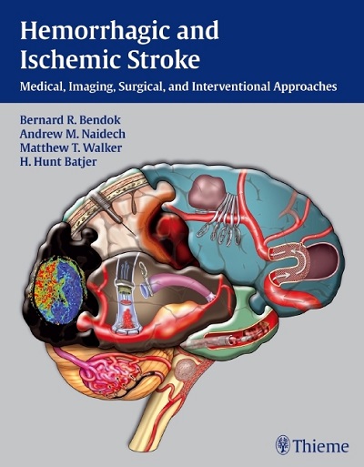 Hemorrhagic and Ischemic Stroke