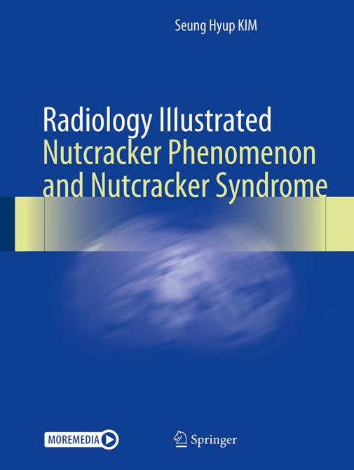 Radiology Illustrated: Nutcracker Phenomenon and Nutcracker Syndrome
